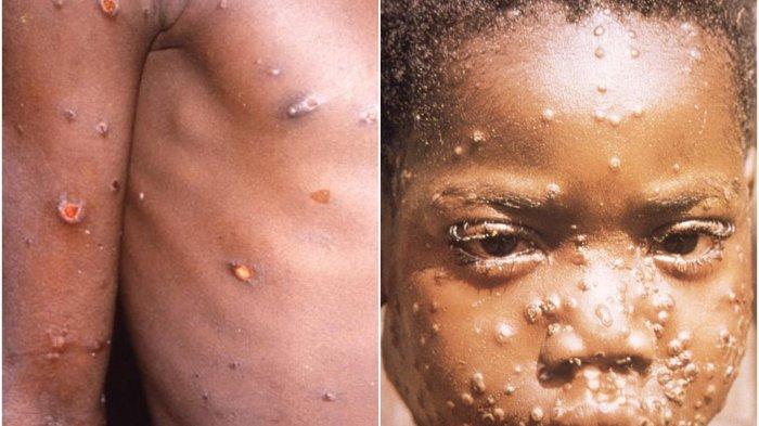 PAFI MAGETAN : WHO Nyatakan Monkeypox sebagai Keadaan Darurat Kesehatan Masyarakat Global